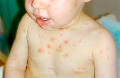 Chicken Pox in Merida Yucatan Mexico